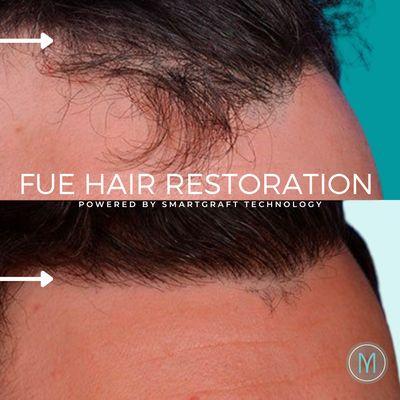 FUE Hair Restoration