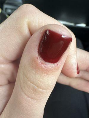 Bleeding cuticle