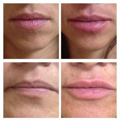 Natural looking lip filler enhancement