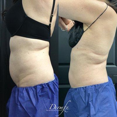 Coolsculpting