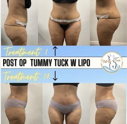 Post op tummy tuck with Lipo 360