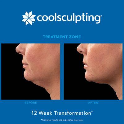 Get $100 OFF first CoolSculpting Treatment!