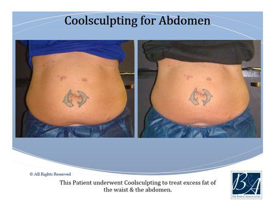 CoolSculpting for Abdomen