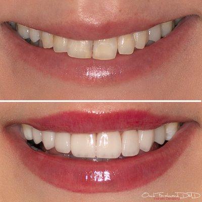 Smile design and transformation using porcelain veneers.