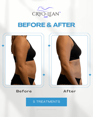 Cryo-Lean, Fat Freezing, Body Contouring, Muscle Toning, Skin Tightening