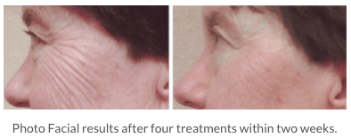 Before and after 4 treatments.