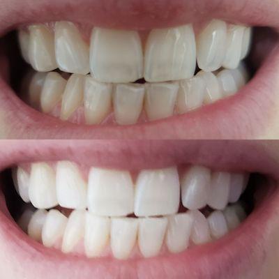 One teeth whitening treatment