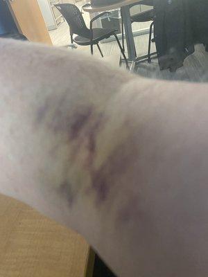 Arm and veins after plasma session at Livonia location on 12-7-2022.