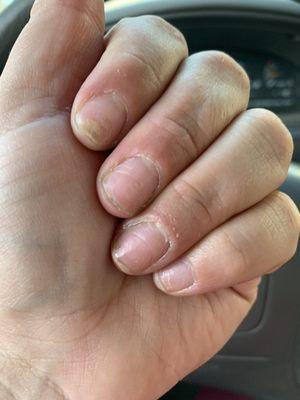 Damaged Nails