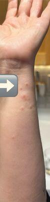 Scabies rash on wrist.