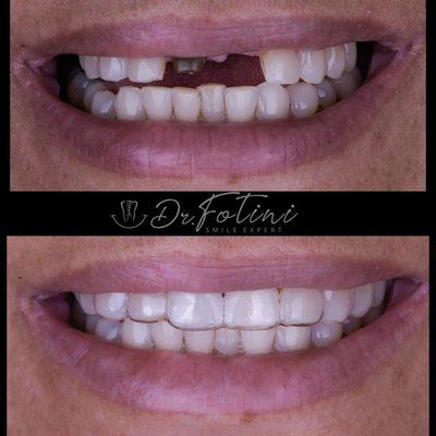 Essix retainer to replace missing teeth. Beautiful results in 24 hours by Dr Chrisopoulos