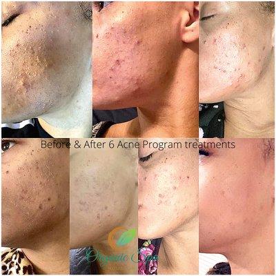 Acne program with proven results by Organic Spa Houston