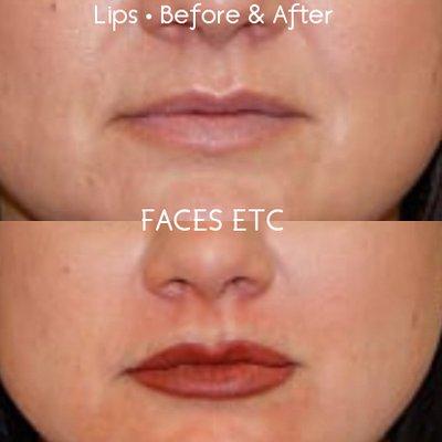 Lips - Before & After