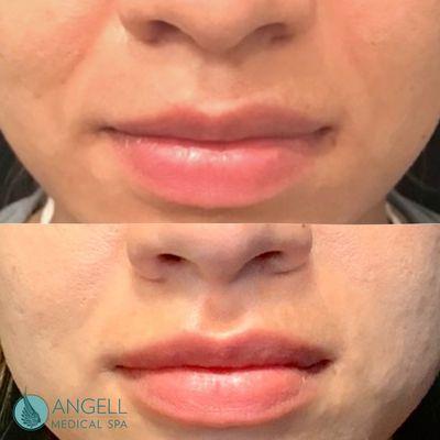 Lip Filler Juvederm