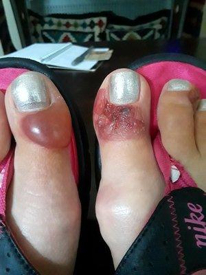 This is what it looks like 12 day's after pedicure! It's now a secondary infection because the blister burst on my right toe.