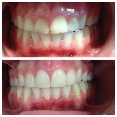 Broken and crowded anterior teeth, placed a bonding filling in the same day with no need for crown or braces. A smile makeover in one visit.