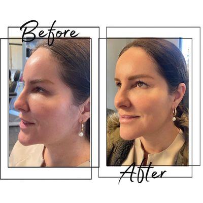 Dermal filler correction.