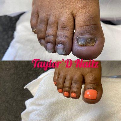 Toenail Restoration with waterless pedicure.