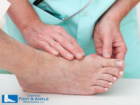 Bunion Treatment