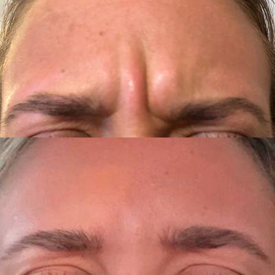 Glabella Botox