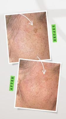 Lighten age and sun spots with as little as ONE treatment! (One treatment of large age spot in photo)