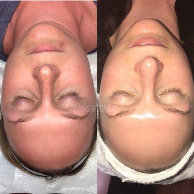 Before & after 3 Microneedling treatments and a facial with LED