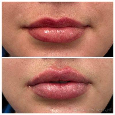 Lip Filler Treatment