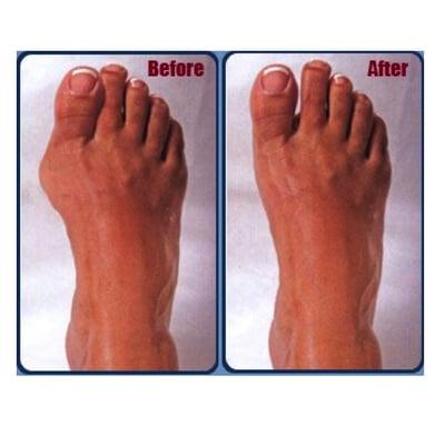 Before and After Minimally Invasive (1-stitch) Bunion Surgery