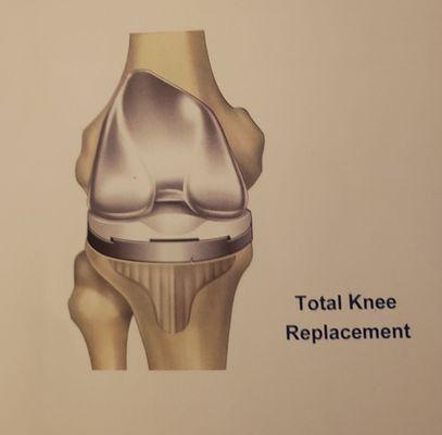 My knee after All Star   helped my handicap rehabilitation recover!