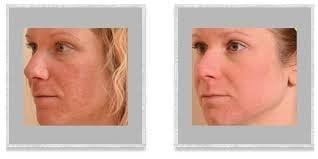 Halo Laser Skin Resurfacing treatment for Melasma Before and After