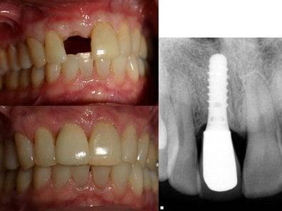 Dental Implants to Replace Missing or Broken Teeth