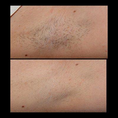 Before and after laser hair removal for the underarms