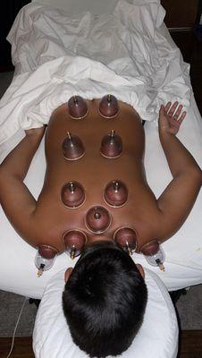 Cupping therapy