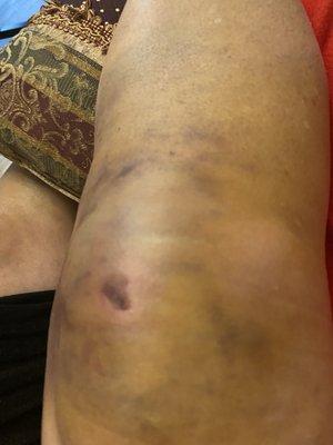 Left knee injury after a fall requiring therapy and lymphedema sessions.