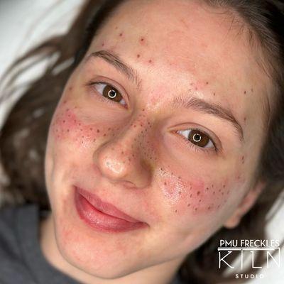 PMU Freckles (Medium coverage) Fresno/Clovis