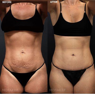 Mini tummy tuck with VASER liposuction