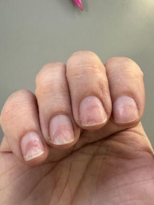 Severely damaged pinky and ring fingernail (right hand)