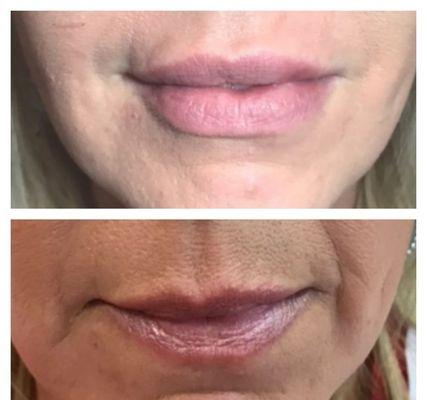 Before and after Bellafill and Versa lip filler.