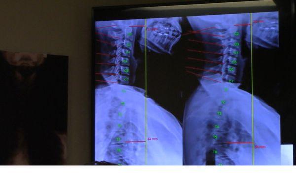 Before and After of cervical spine  (patient had migraines for 10 years PRIOR to treatment)