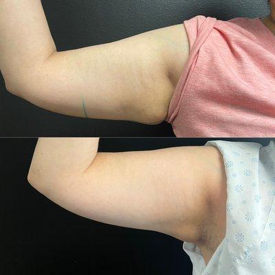 Coolsculpting Before and After! Arms!