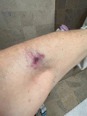 Bruise caused by phlebotomist at 210 Westmed. Day of blood draw.