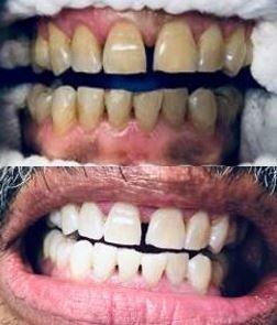 Before & After Zoom Treatment