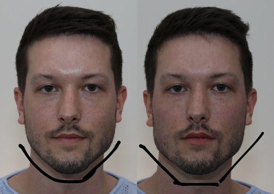 Jawline sculpting with filler: creating a more masculine, chiseled jawline