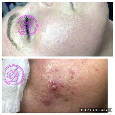 Happy Client of secrets of beauty for over 6 years..  picture in top is her skin today!.