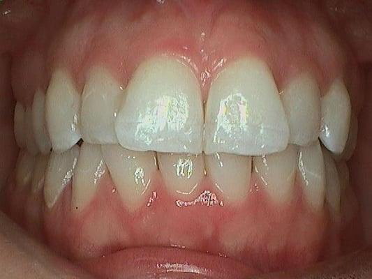 Orthodontic correction with Clear Braces in about 8 months of treatment. This is 'before' photo. 
 Presidio Dental San Francisco