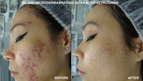 6month Skin Rejuvenation Program