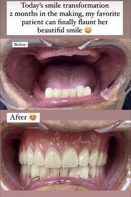 Full upper denture
And lower denture