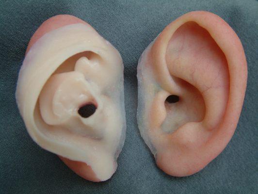 ear prosthesis