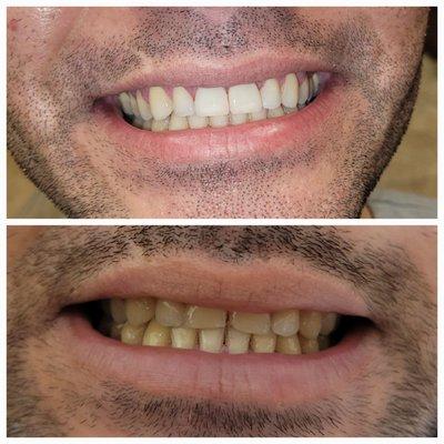 Mini smile makeover of front upper 2 teeth. Beautiful veneers that look natural