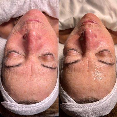 Hydration Facial